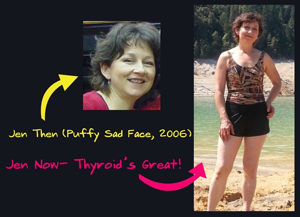 Hypothyroid (Puffy Face Picture)